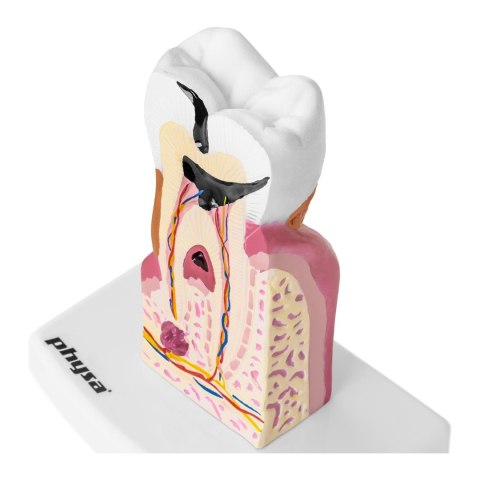 MODEL ANATOMICZNY CHOREGO ZĘBA CZŁOWIEKA W SKALI 6:1